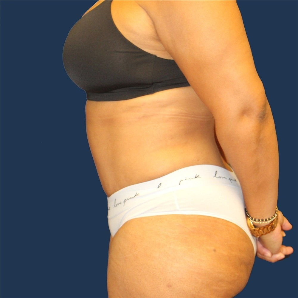 Tummy tuck after (body surgery)