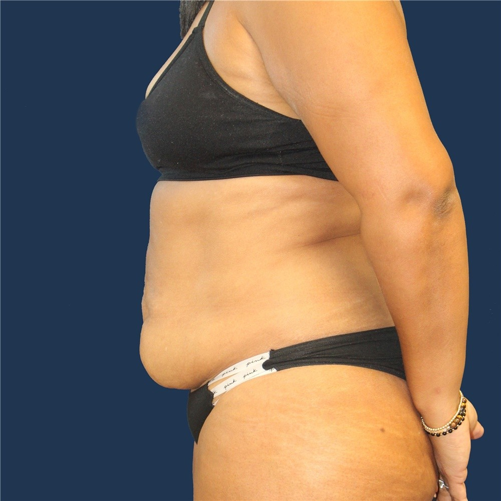 Tummy tuck before